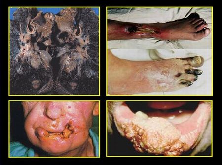 Pictures Of Lung Cancer Caused By Smoking